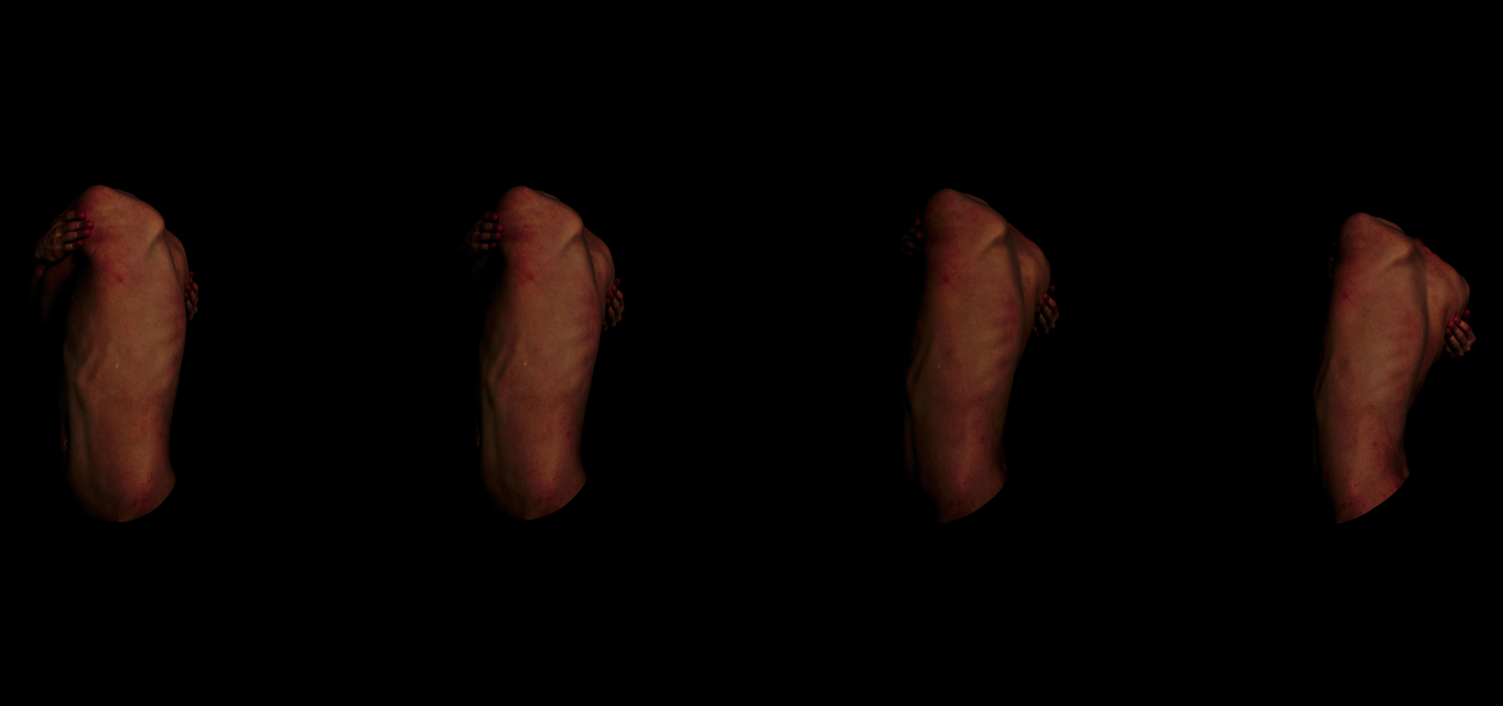 A series of four photographs showing Craig's back. His skin is red and inflamed.