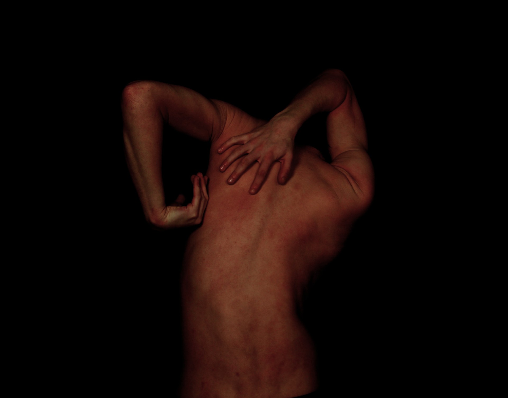 Craig is standing with his back facing the camera. His back is red and inflamed.