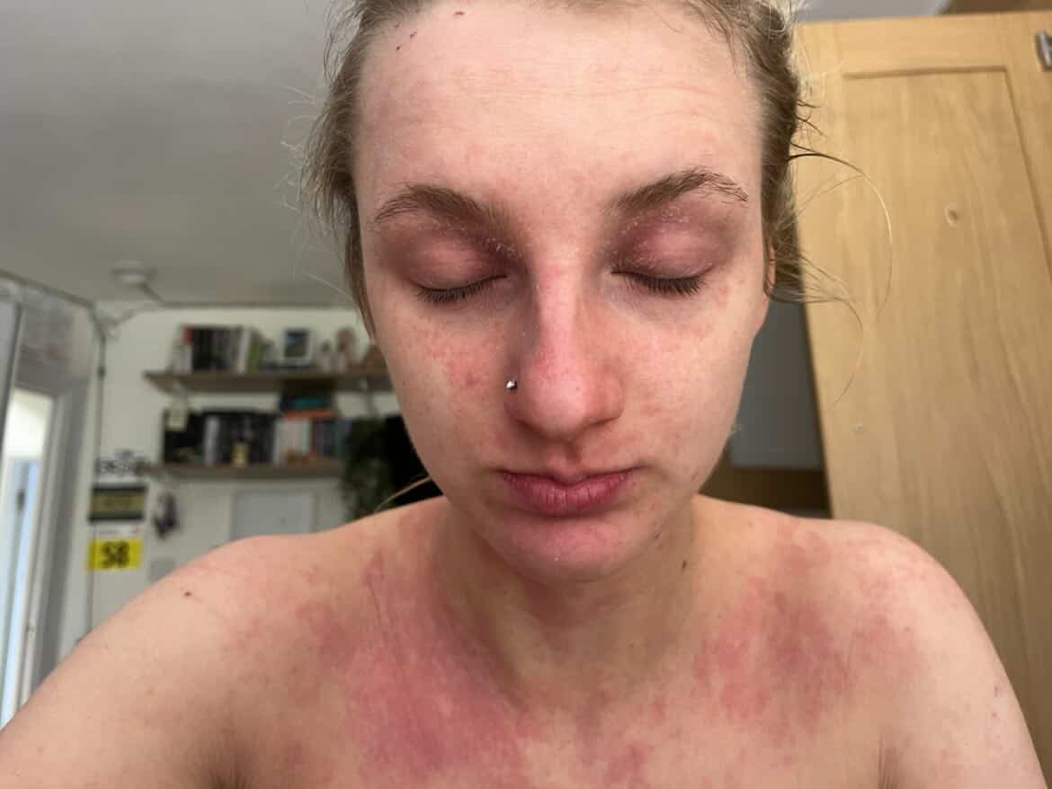 A photo of Isla during an eczema flare up. Her skin is red and very dry.