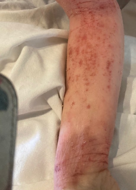 A picture of ruths arm, which is red from eczema