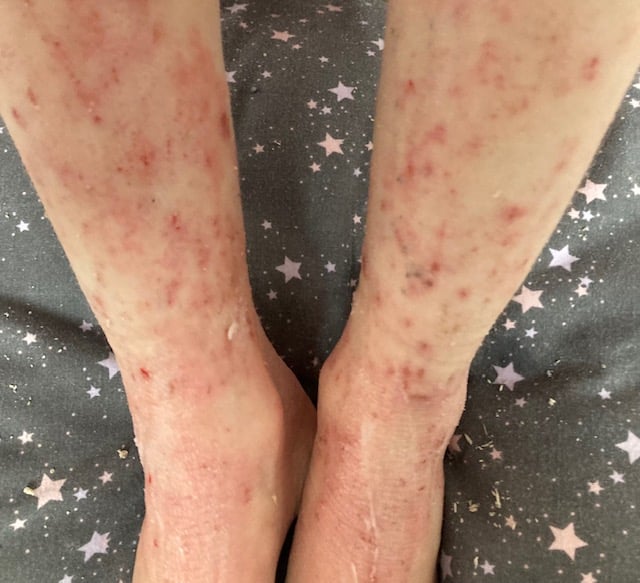 A picture of ruths legs, which are very sore and red from eczema