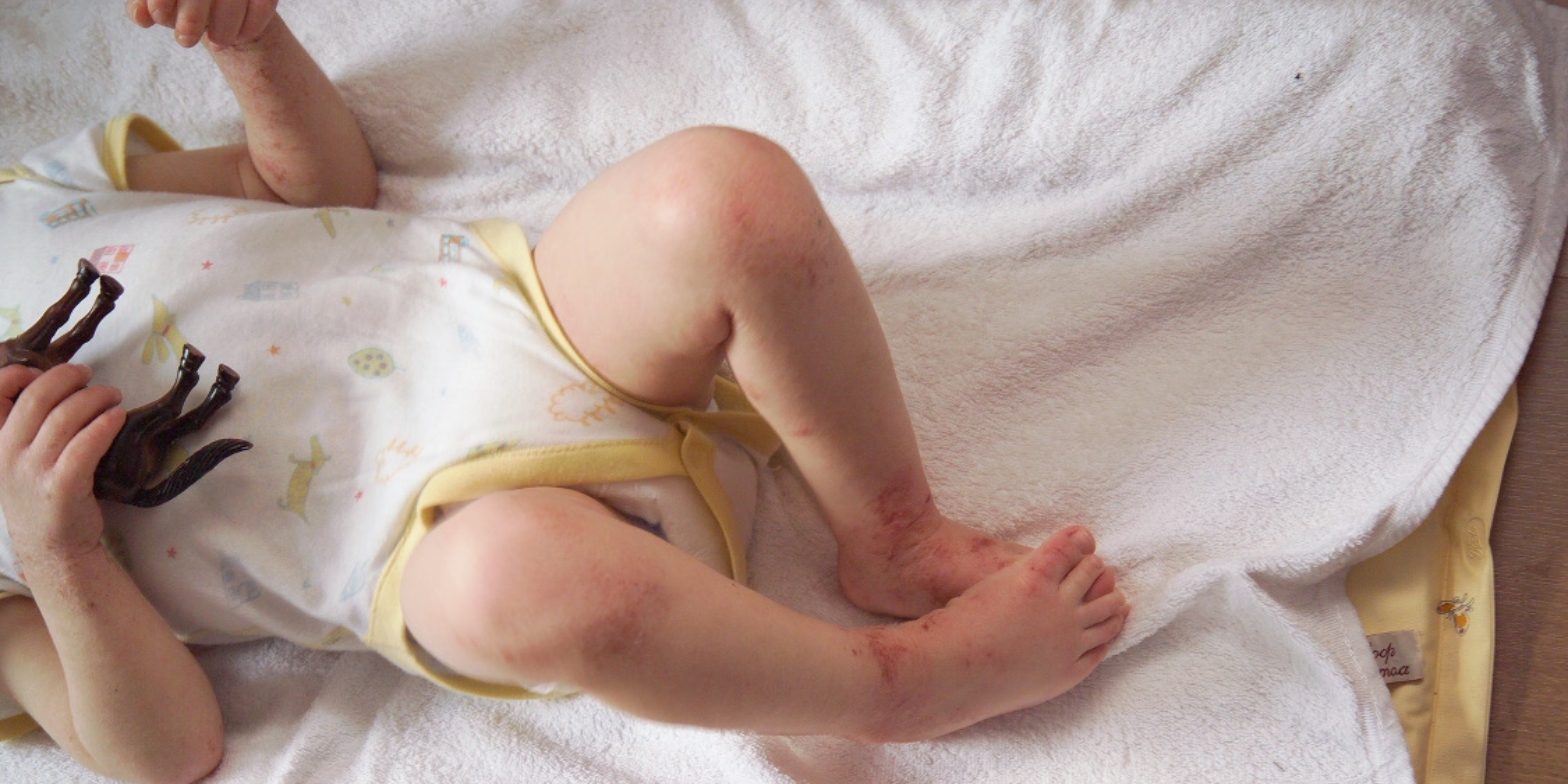 A baby lying on a blanket who has mild eczema on their feet and legs.