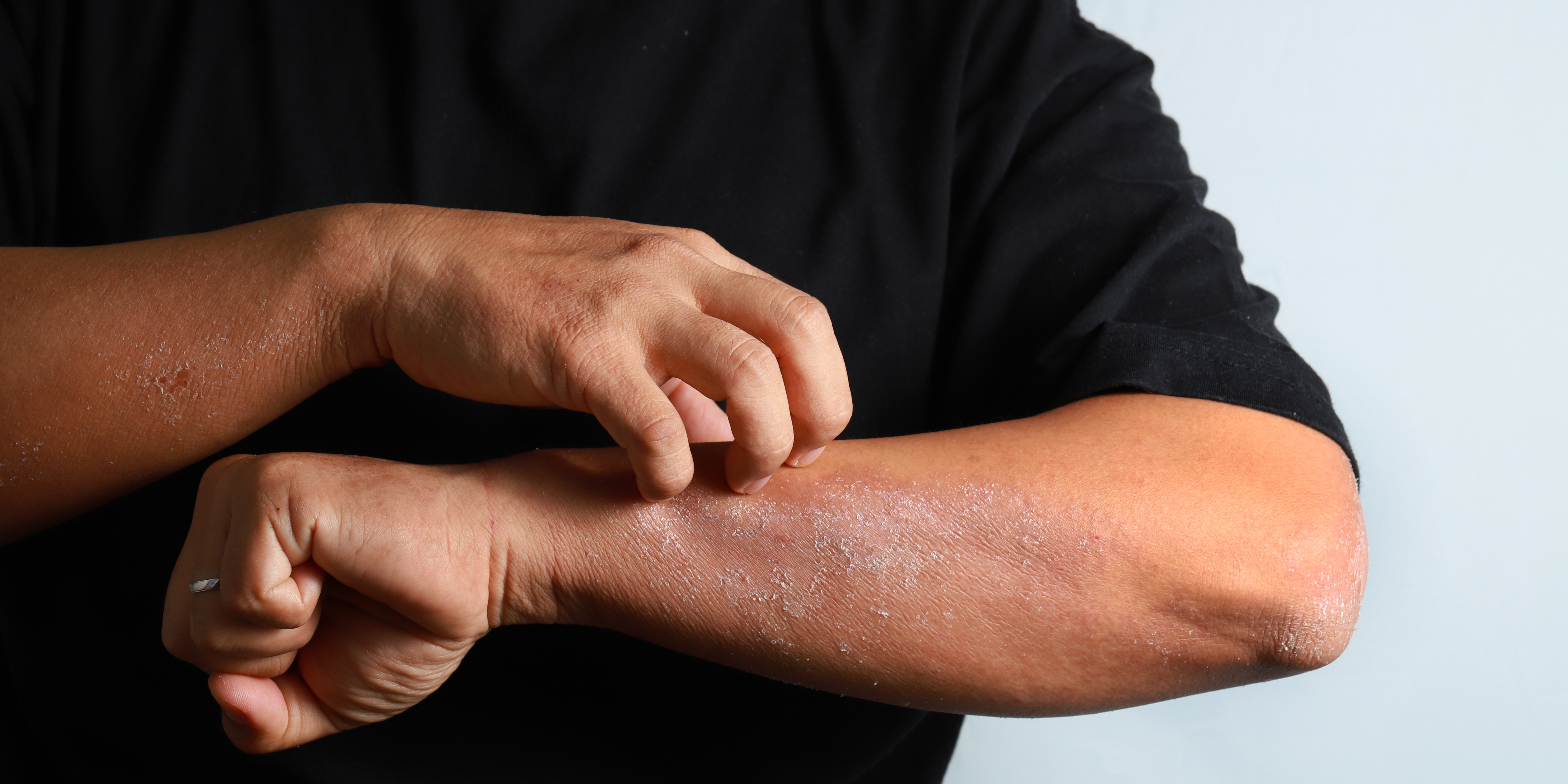 A shot of a persons arms, who is suffering from eczema.
