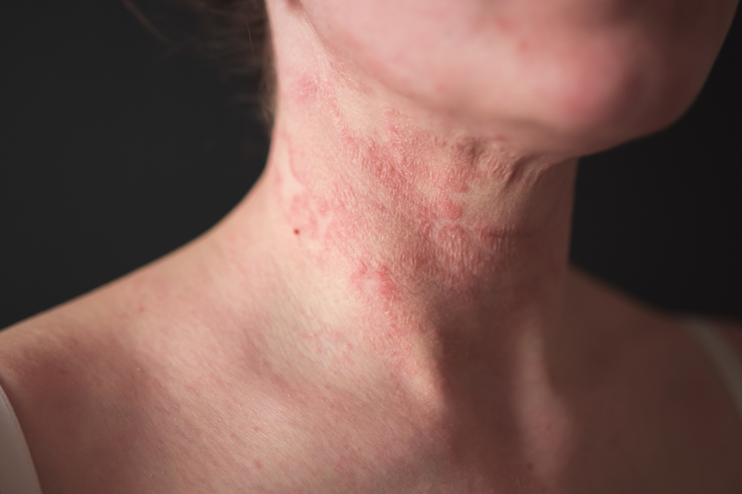 A picture of a neck that has eczema